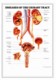 3D ANATOMICAL CHART DISEASES OF THE URINARY TRACT.