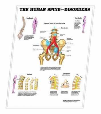 3D ANATOMICAL CHART THE HUMAN SPINE - DISORDERS.