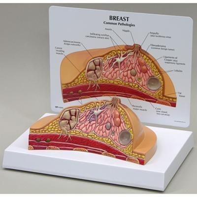 Picture of 3D ANATOMICAL CHART UNDERSTANDING BREAST CANCER