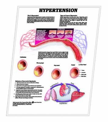 Picture of 3D ANATOMICAL CHART HYPERTENSION
