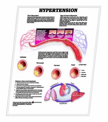 Picture of 3D ANATOMICAL CHART HYPERTENSION