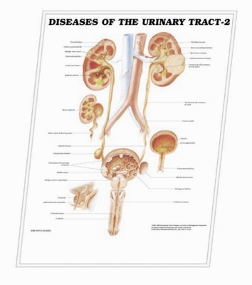 Picture of 3D ANATOMICAL CHART DISEASES OF THE URINARY TRACT