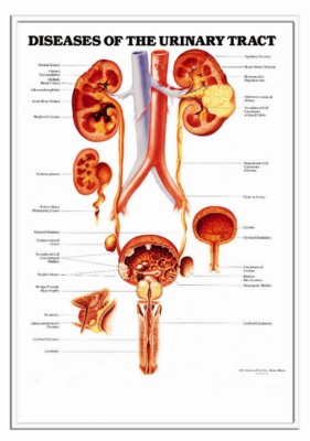 Picture of 3D ANATOMICAL CHART DISEASES OF THE URINARY TRACT