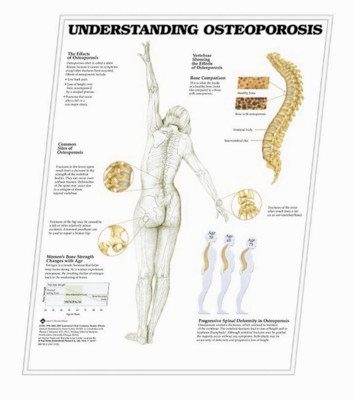 Picture of 3D ANATOMICAL CHART UNDERSTANDING OSTEOPOROSIS