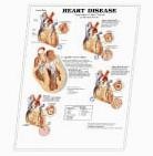 Picture of 3D ANATOMICAL CHART HEART DISEASE
